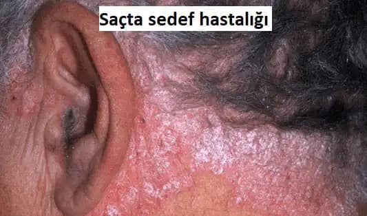 Kasıkta Sedef Hastalığı ve Cilt Sağlığını Koruma Yöntemleri