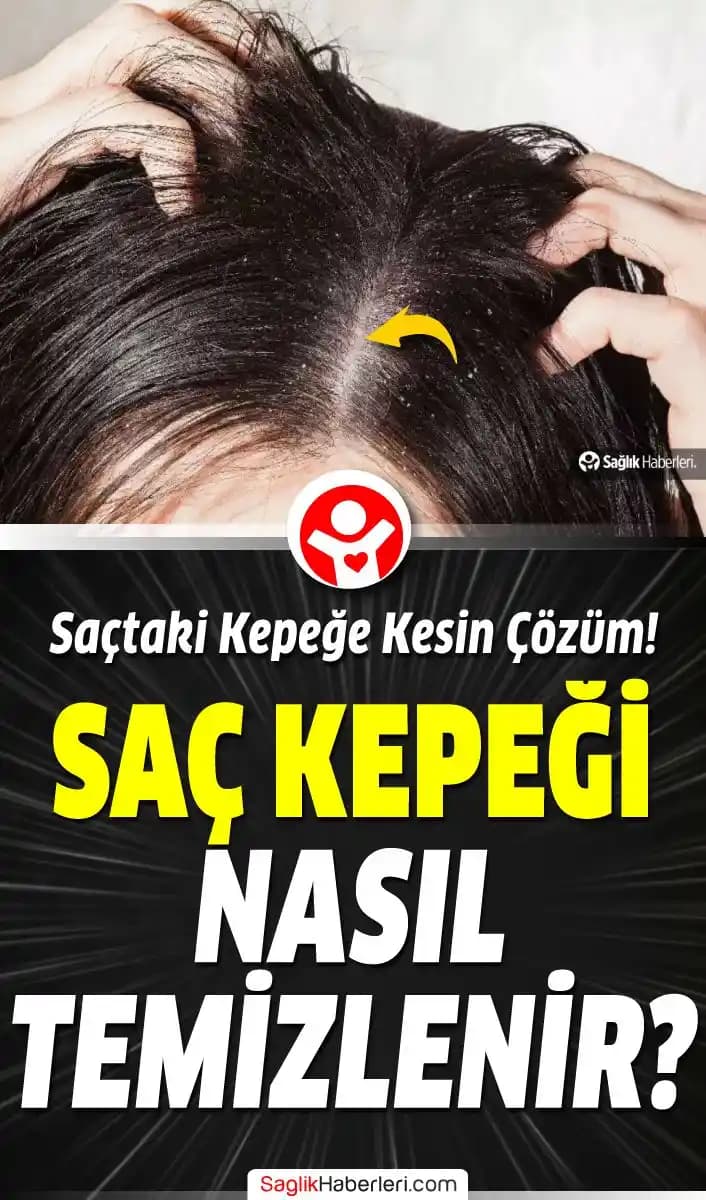 Kepek Nasıl Giderilir? Etkili Yöntemler ve Saç Sağlığı İpuçları