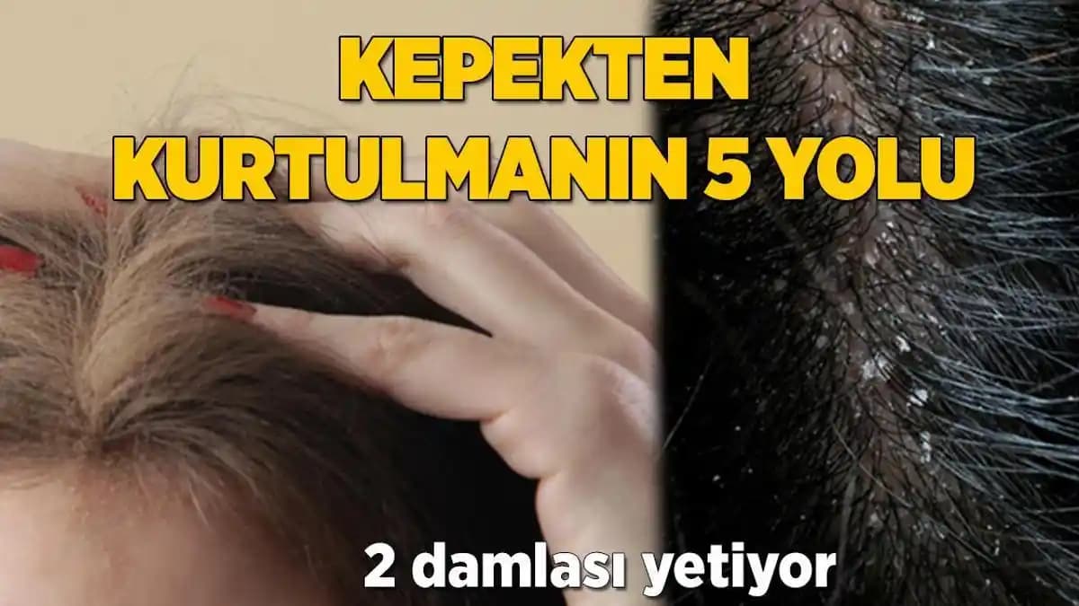 Kepekten Arınmak İçin Etkili Yöntemler ve Saç Sağlığını Korumak İpuçları