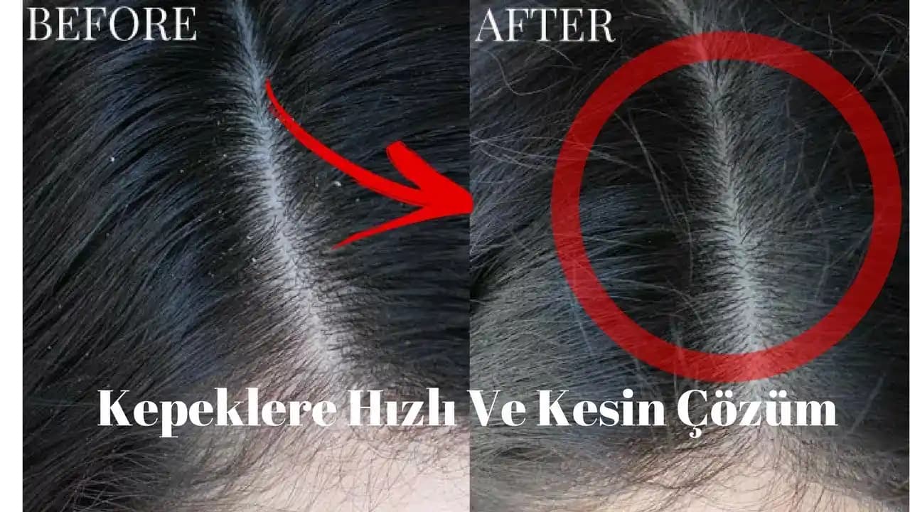 Kepekten Kurtulmanın Yolları ve Sağlıklı Saçlar İçin Uzman Rehberi