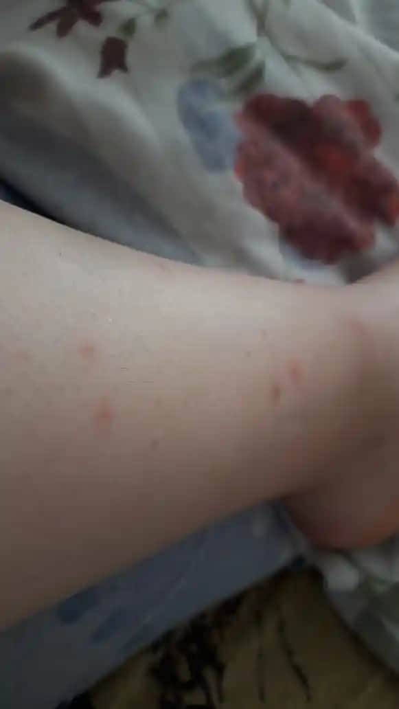 Kılcal İzler ve Ciltteki İzleri Azaltma Yöntemleri Kozmetik ve Doğal Yaklaşımlar