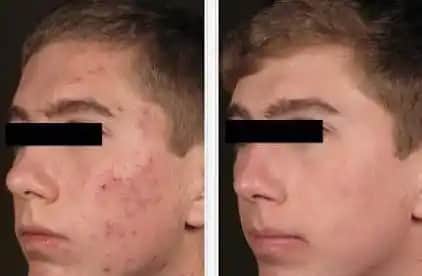 Kırmızı Sivilce İzleriyle Başa Çıkma Yöntemleri ve Etkili Tedavi Seçenekleri