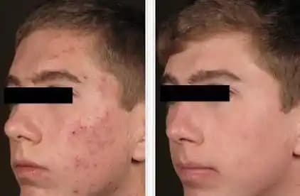 Kırmızı Sivilce İzleriyle Başa Çıkma Yöntemleri ve Etkili Tedavi Seçenekleri