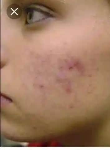 Kırmızı Sivilce Lekeleri: Nedenleri, Tedavi Yöntemleri ve Cilt Bakımında Dikkat Edilmesi Gerekenler