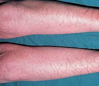 Kış Egzaması İçin Kozmetik ve Bakım Yaklaşımlarıyla Cilt Koruma Rehberi