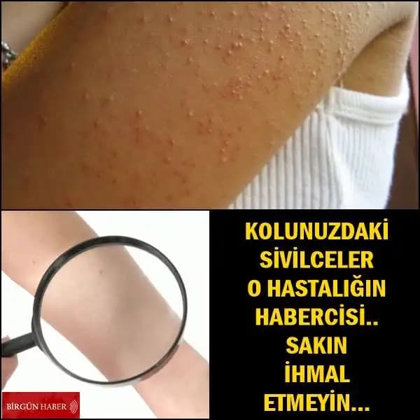 Kol Arkası Sivilceleri Nedenleri ve Etkili Tedavi Yöntemleri Hakkında Bilmeniz Gerekenler