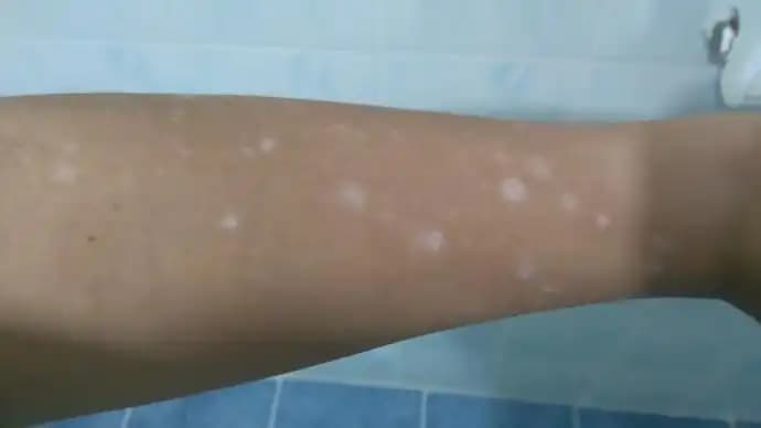 Kolda Leke Nedenleri ve Kozmetik Yaklaşımlarla Etkili Tedavi Yöntemleri