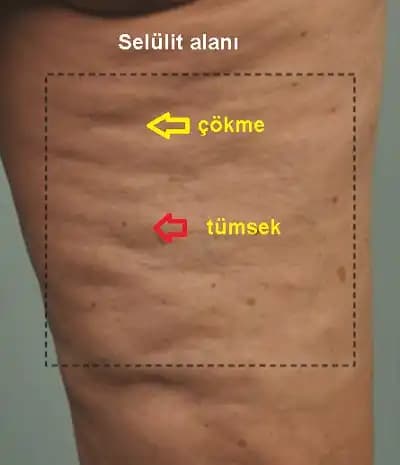 Kolda Selülit İçin Kozmetik ve Doğal Çözümlerle Etkili Tedavi Yöntemleri
