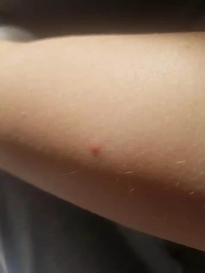 Kolda Sivilce Nedenleri ve Çözüm Yolları Hakkında Detaylı Rehber