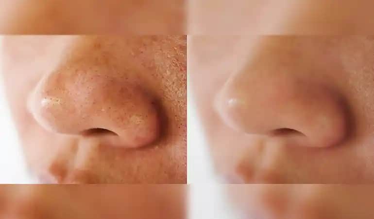 Kolda Siyah Nokta Sorunu Nedenleri ve Etkili Çözüm Yöntemleri