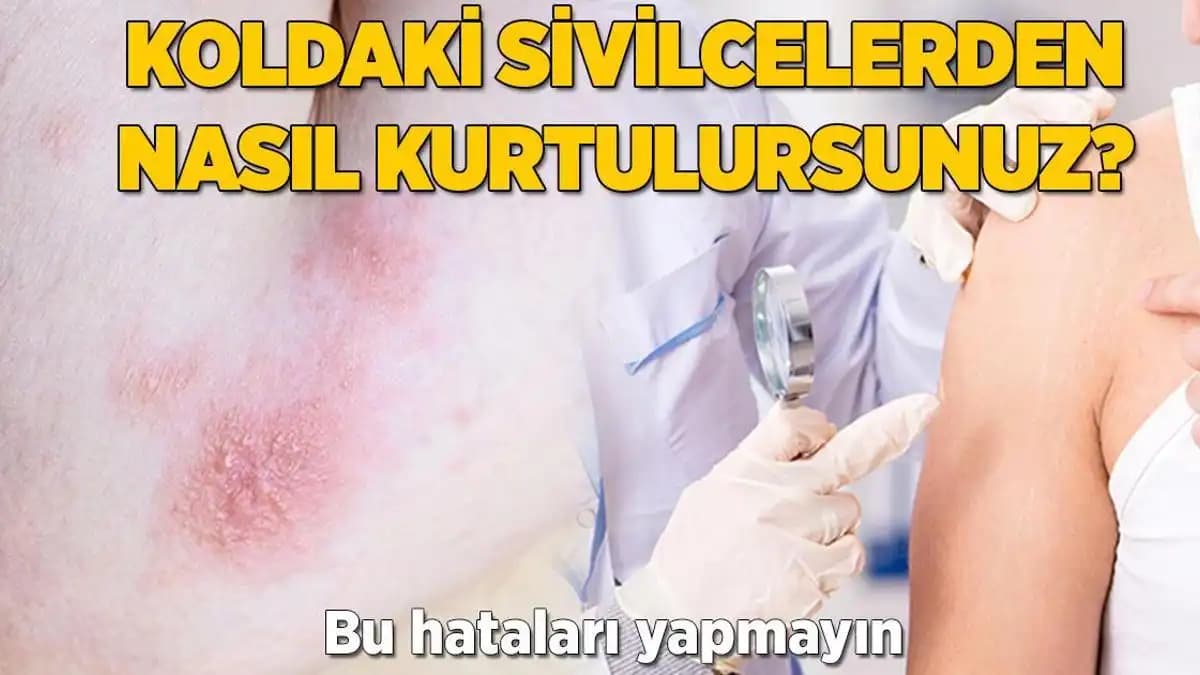 Koldaki Sivilceler: Nedenleri, Korunma Yöntemleri ve Etkili Kozmetik İpuçları
