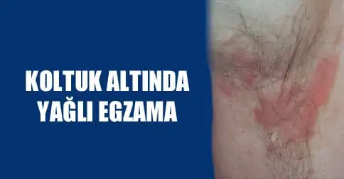 Koltuk Altı Egzaması Belirtileri ve Etkili Yönetim Yöntemleri Hakkında Kapsamlı Rehber