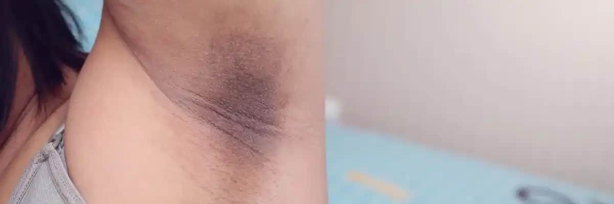 Koltuk Altı Kararması ve Çözüm Yolları: AHA ve BHA ile Parlak Bir Cilt İçin Rehber