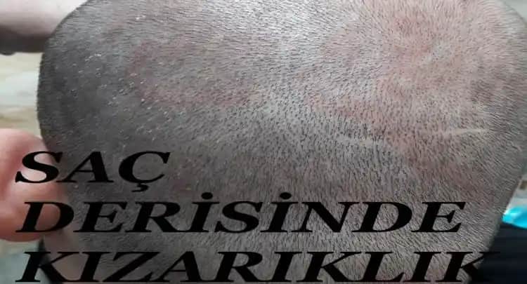 Kozmetik Ürünleri Kullanımında Cilt Kızarıklığı Nedenleri ve Etkili Çözüm Yolları