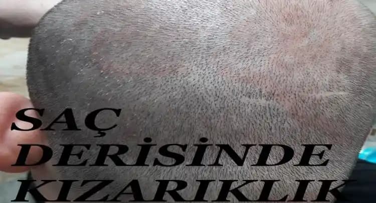 Kozmetik Ürünleri Kullanımında Cilt Kızarıklığı Nedenleri ve Etkili Çözüm Yolları