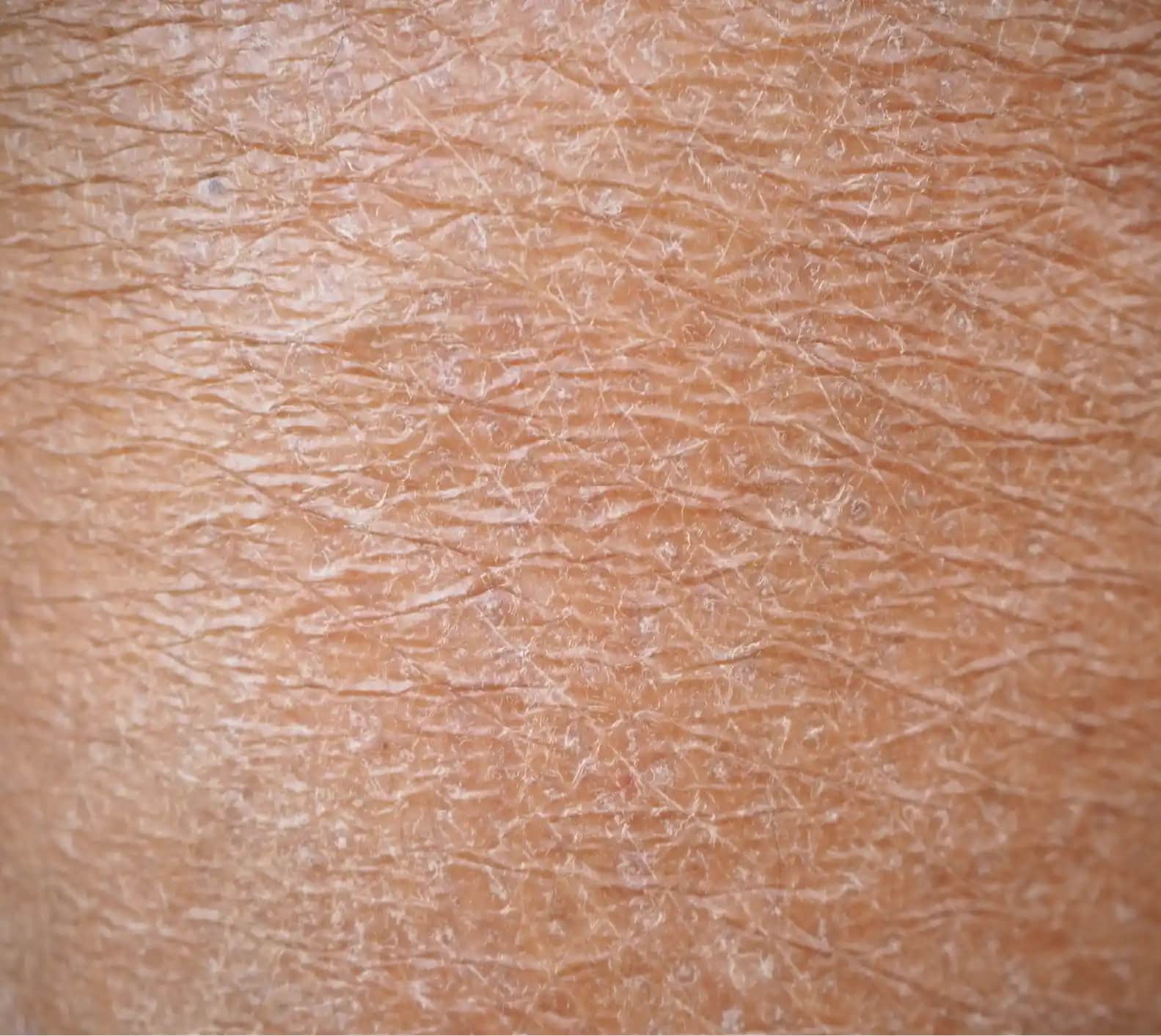 Kuru Ciltle Mücadelede En Etkili Kozmetik Yaklaşımlar ve Bakım İpuçları