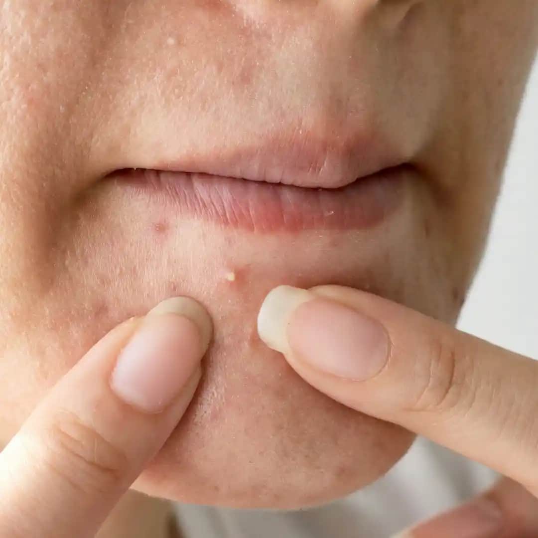 Kuru Ciltte Sivilce Problemi ve Doğru Bakım Yöntemleri Hakkında Kapsamlı Rehber