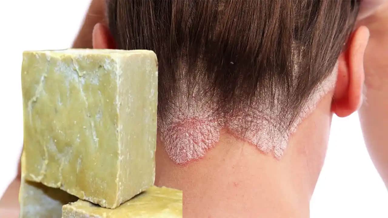 Kuru Egzama Nedir, Belirtileri ve Etkili Başa Çıkma Yöntemleri