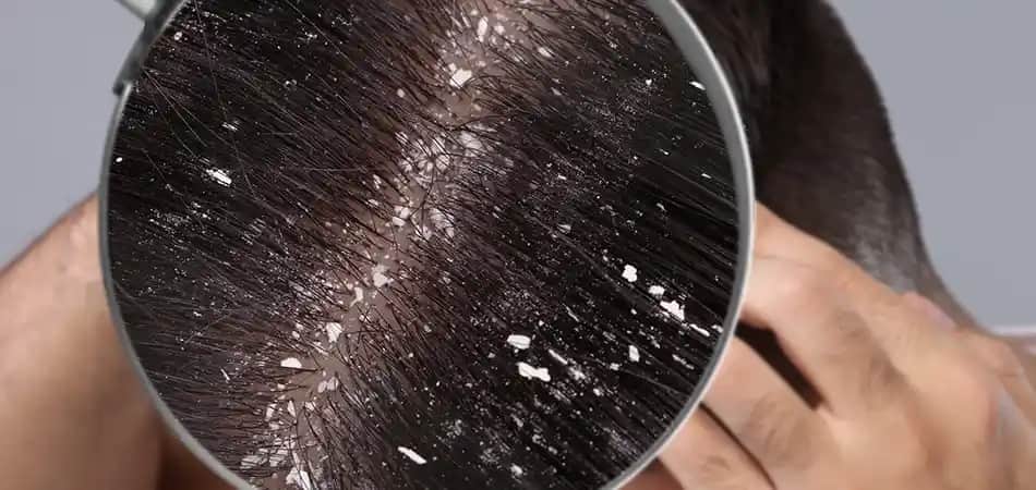 Kuru Kepek Nasıl Geçer Sağlıklı ve Parlak Saçlar İçin Etkili Yöntemler