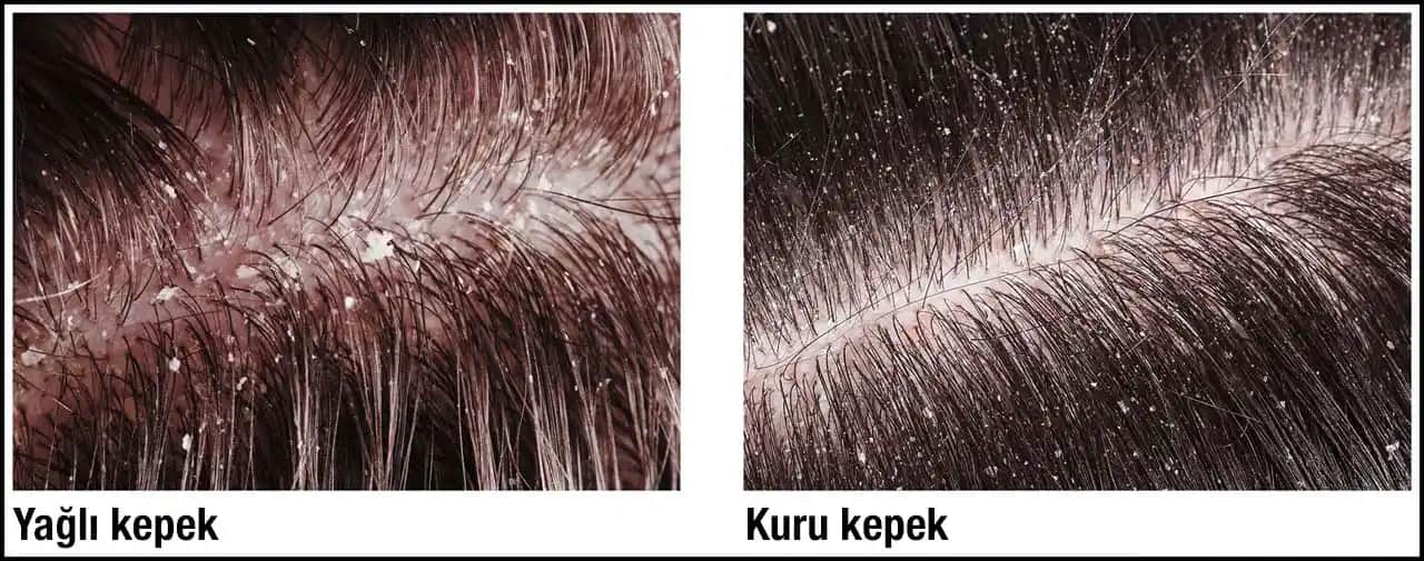 Kuru Kepek Nedenleri ve Etkili Çözüm Yöntemleri Rehberi