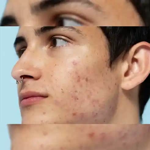 Kuyruk Sokumunda Sivilce Nedenleri ve Etkili Çözüm Yolları