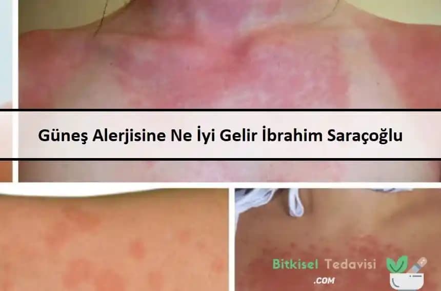 Lazer Alerjisi Nedir, Belirtileri ve Hafifletici Yöntemler Hakkında Detaylı Bilgi