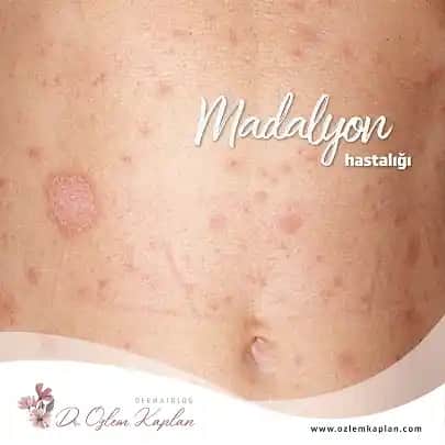 Madalyon Hastalığı İçin Etkili Krem: Cilt Sağlığını Koruyan ve Geliştiren Çözümler