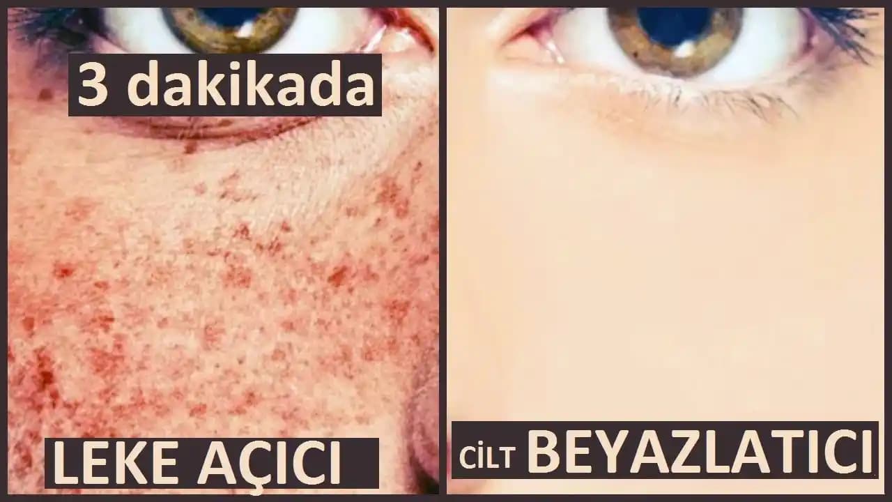 Mor Lekeler ve Kozmetik Yaklaşımlarla Doğru Çözüm Yöntemleri