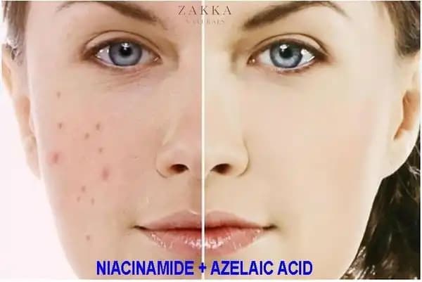 Niacinamide ve Azelaic Asid Birlikteliği: Cilt Sağlığı İçin Güçlü Bir Kombinasyon Mu?
