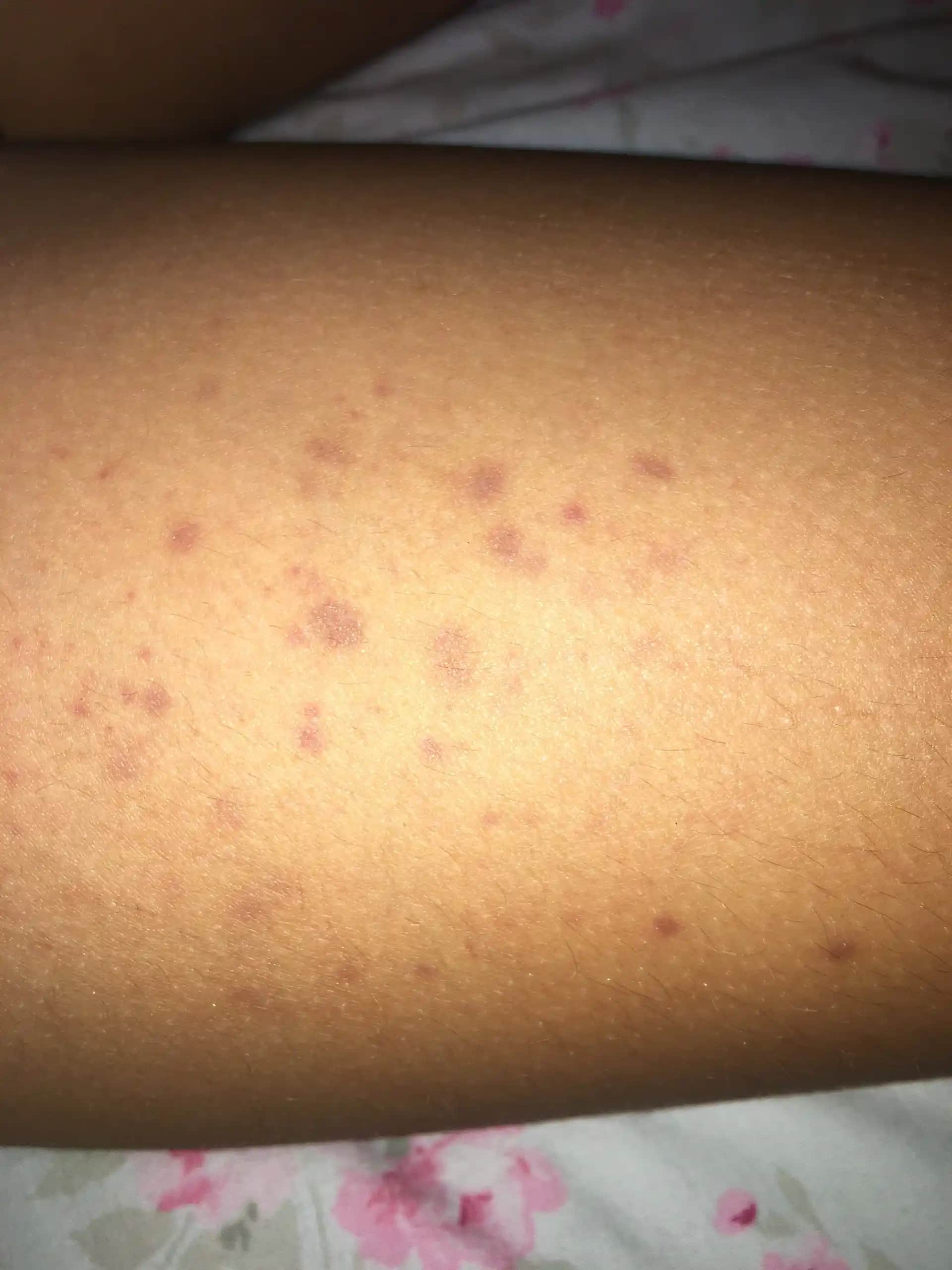 Nokta Nokta Morluklar: Cilt Sağlığı ve Güzellikte Etkili Çözüm Yolları