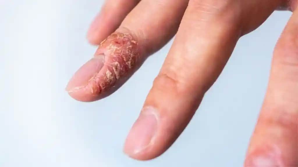 Parmak Arası Egzaması ve Kozmetik Yaklaşımlar: Belirtiler, Tedavi ve Koruma Yöntemleri