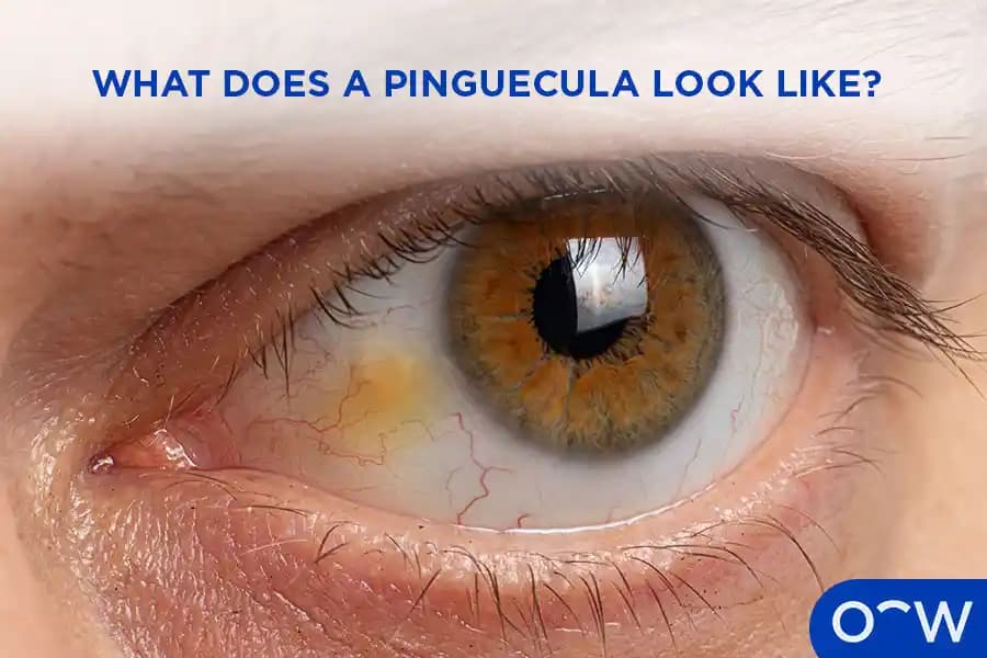 Pinguekula Nedir, Zararları ve Estetik Çözüm Yöntemleri Hakkında Detaylı Bilgi