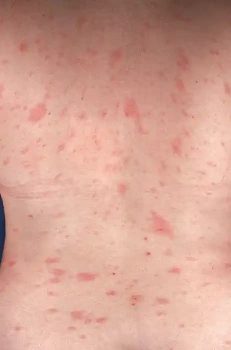 Pityriasis Rosea ve Gül Hastalığı: Kozmetik ve Sağlık Açısından Detaylı İnceleme