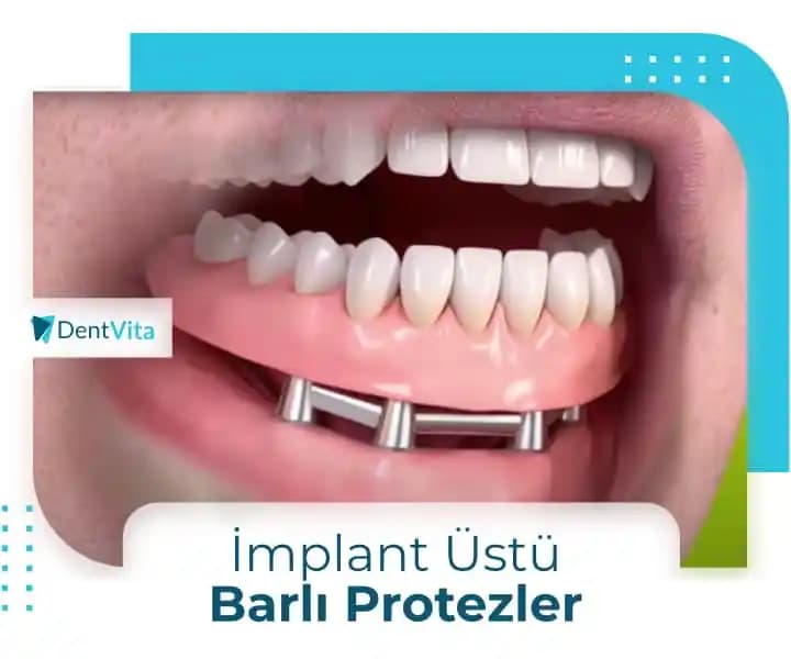 Protez Diş Sabitleyicileri: Ağız Sağlığı ve Konfor İçin Güvenilir Çözümler