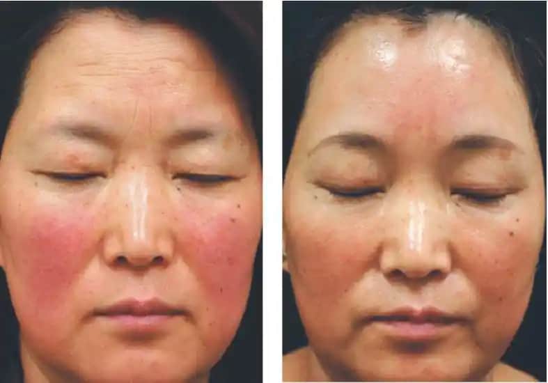 Roza Lazer Tedavisi ile Cilt Güzelliğinde Modern ve Etkili Çözümler