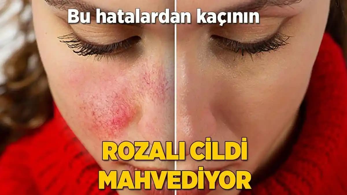Rozalı Cilt Belirtileri, Nedenleri ve Doğru Bakım Yöntemleri Hakkında Bilgilendirici Rehber