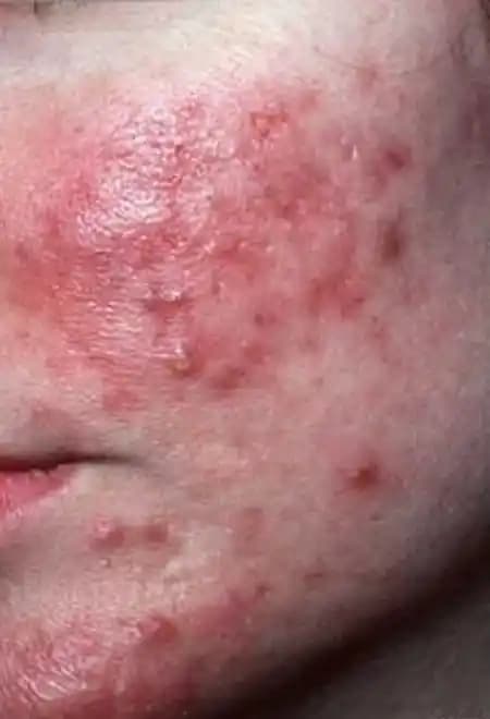 Rozasea Hastalığı ve Kozmetik Bakımda Uygun Ürün Seçimi Rehberi