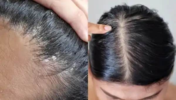 Saç Derisi Kalkması Nedenleri Belirtileri ve Etkili Çözüm Yöntemleri