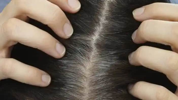 Saç Derisi Kaşıntısının Nedenleri ve Çözüm Yolları Hakkında Kapsamlı Bilgi