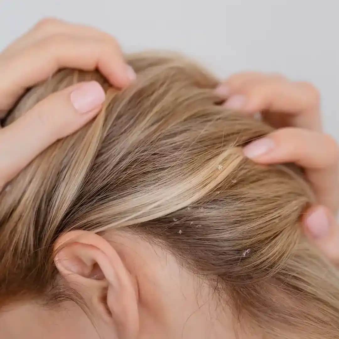 Saç Derisi Kuruluğu Nedenleri ve Etkili Tedavi Yöntemleri Hakkında Bilgilendirici Rehber