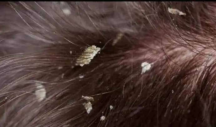 Saç Derisinde Beyaz Tortu Nedenleri, Belirtileri ve Çözüm Yolları Hakkında Kapsamlı Bilgi