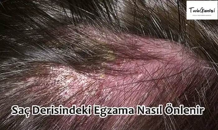 Saç Derisinde Egzama Nedenleri, Belirtileri ve Etkili Tedavi Seçenekleri