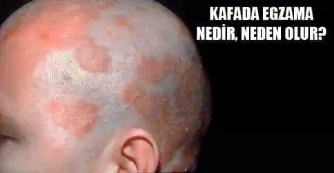 Saç Derisinde Egzama Nedir, Nedenleri ve Etkili Tedavi Yöntemleri Hakkında Bilgiler