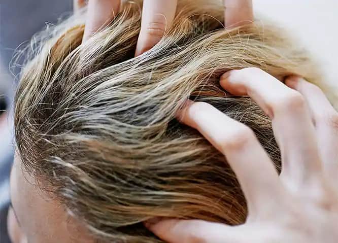 Saç Derisinde Kabuklanma Nedenleri, Belirtileri ve Etkili Tedavi Yöntemleri