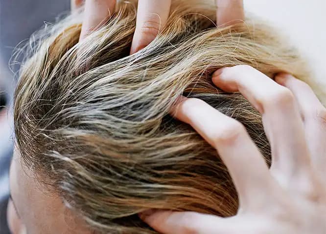 Saç Derisinde Kabuklanma Nedenleri, Belirtileri ve Etkili Tedavi Yöntemleri