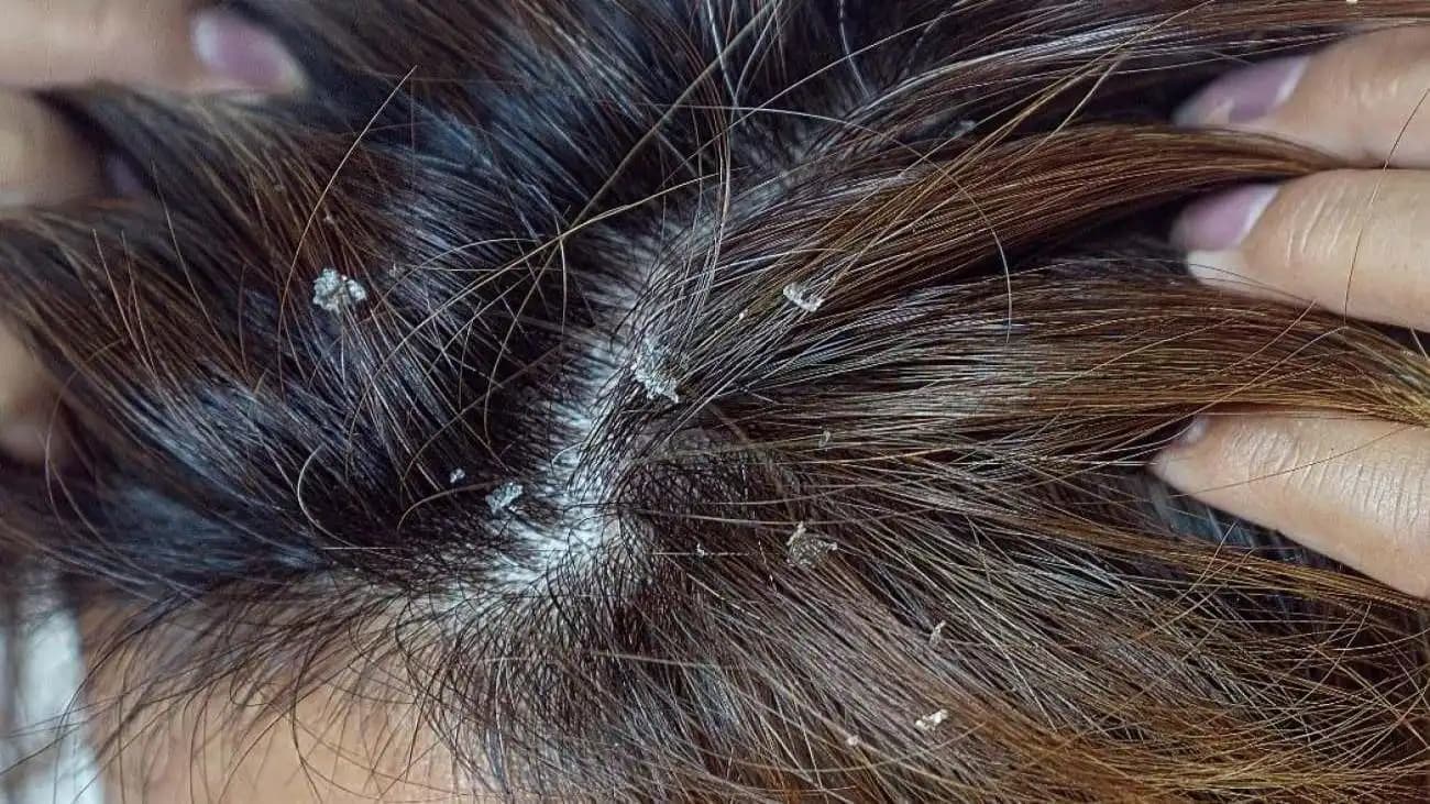 Saç Derisinde Kepek Neden Olur ve Etkili Çözüm Yolları Hakkında Detaylı Bilgi