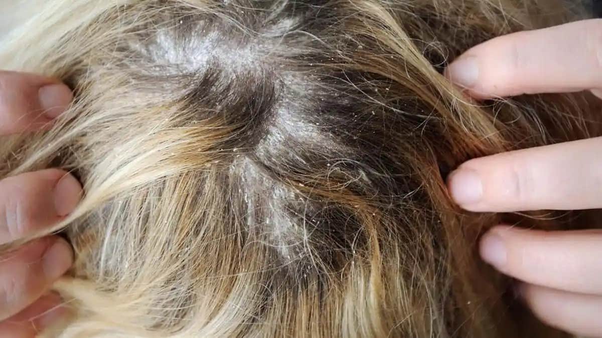 Saç Derisinde Kepek ve Kaşıntı Sorunları İçin Etkili Çözüm ve Bakım Rehberi