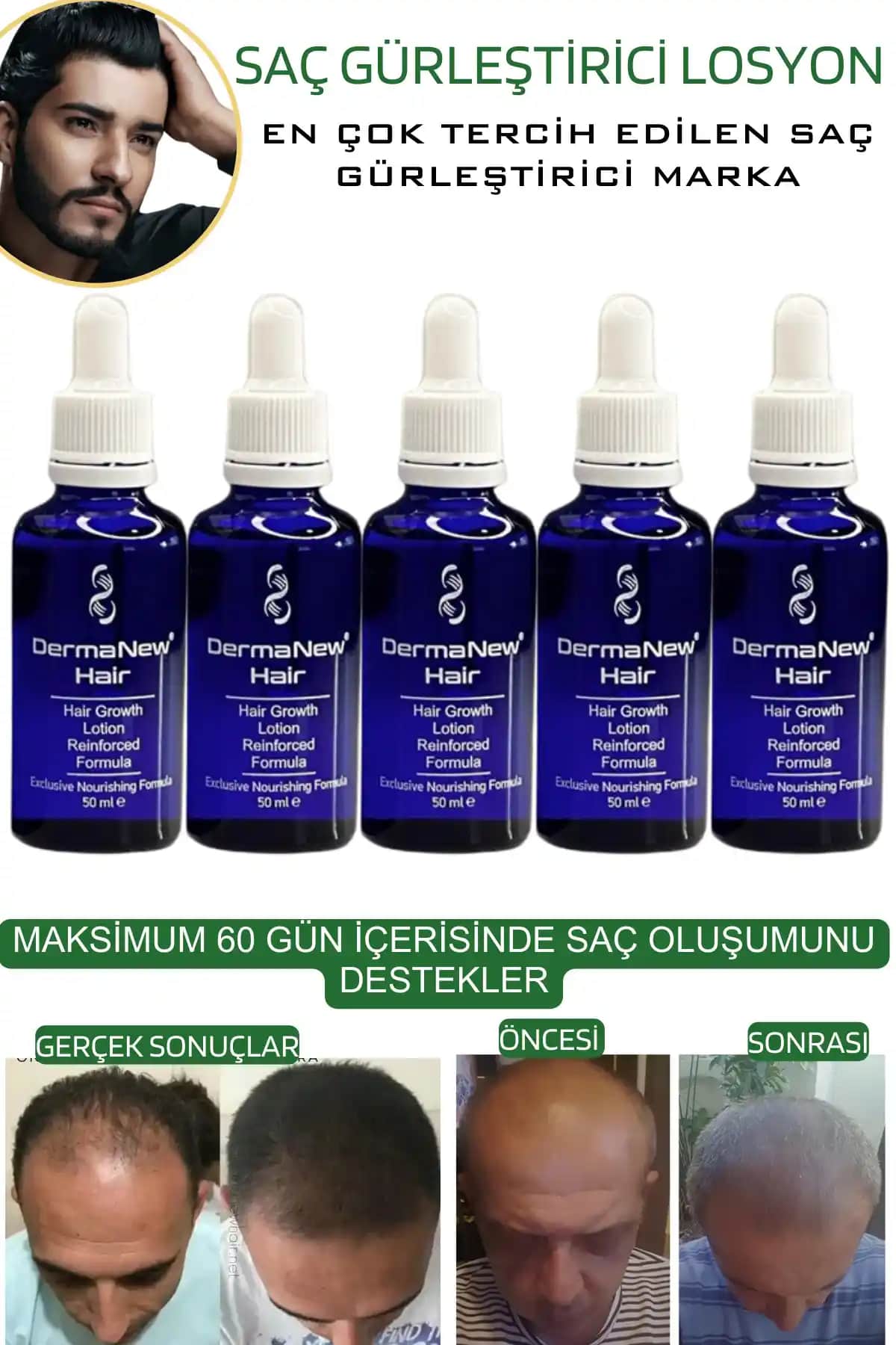 Saç Derisinde Pullanma ve Doğal Çözüm Yöntemleri ile Sağlıklı Saç Derisi