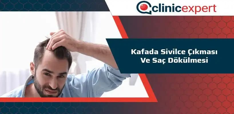 Saç Derisinde Sivilce Nedenleri ve Etkili Tedavi Yöntemleri Hakkında Kapsamlı Bilgi