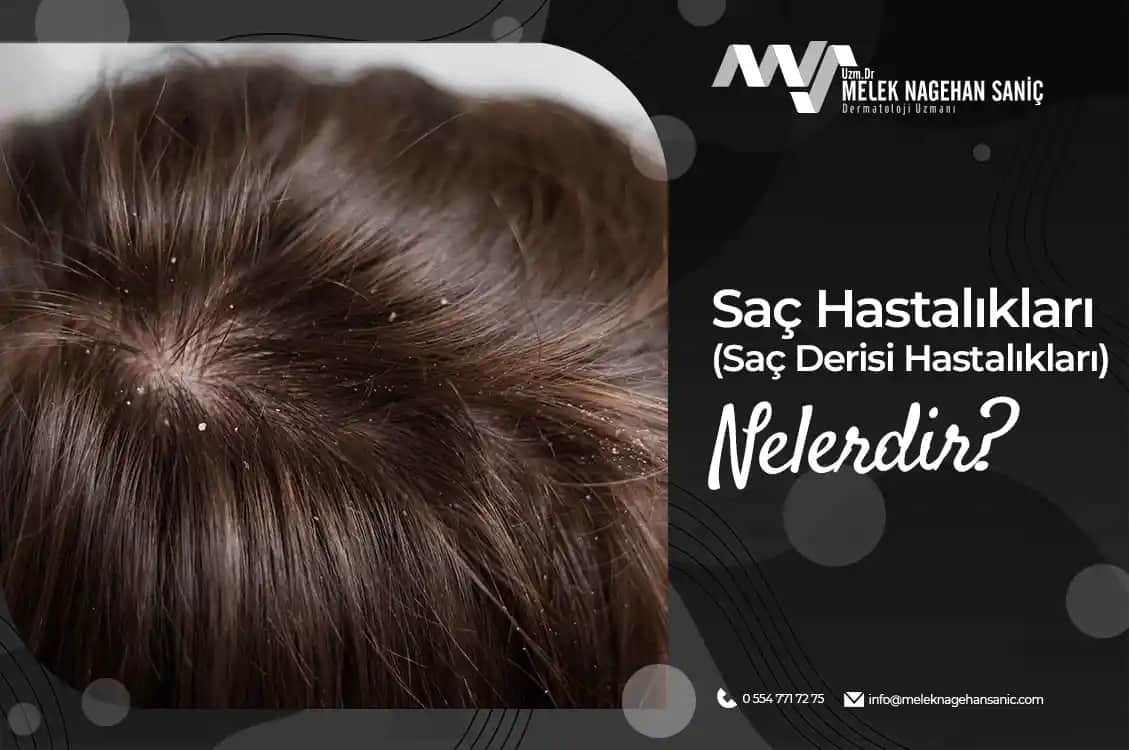 Saç Derisinde Sivilce Nedenleri ve Sağlıklı Saç Derisi İçin Alınabilecek Önlemler